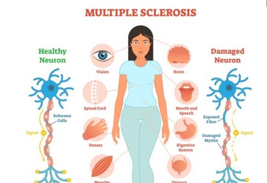multiple sclerosis